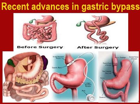 Recent Advances In Gastric Bypass Lap Band Surgery