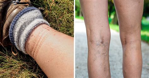 4 Health Issues That Sock Marks May Signal Bright Side