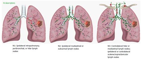 Revisions To The Tumor Node Metastasis Staging Of Lung Cancer 8th