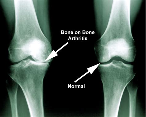 arthritis larson sports  orthopaedics