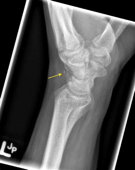 triquetral fracture radiology  st vincents university hospital