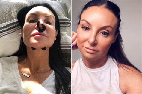 Plastic Surgery Destroyed My Nose — But I Fixed It With