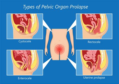 What Is Pelvic Organ Prolapse And The Best Treatment For