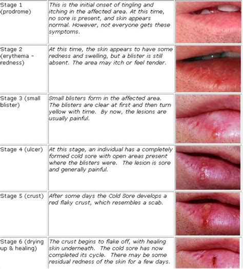 how to reduce the visible signs of cold sore