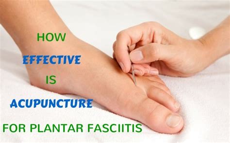 How Effective Is Acupuncture For Plantar Fasciitis Blogmilk