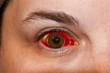 Pictures of Eye Injury Broken Blood Vessels