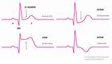 St Elevated Myocardial Infarction Pictures