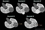 Malignant Renal Cyst Photos