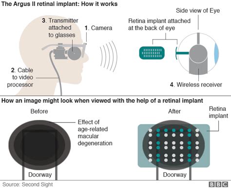 treatment  blindness nhs  install bionic eyes   patients