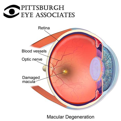 macular degeneration pittsburgh eye associates