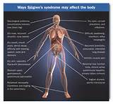 Sjogren''s Syndrome Symptoms