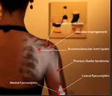 Shoulder Injuries Images