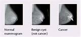 Images of Benign Vs Malignant Breast Lumps