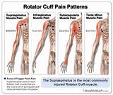 Images of Rotator Cuff Symptoms Of Injury