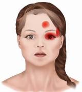 Cluster Headache Images