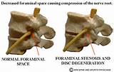 Foraminal Stenosis Causes