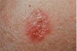 Photos of Carcinomas Are Cancers Of The