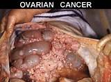 Images of Ovarian Cancer Pelvic Pain