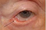 Stenosis Eye Images