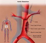 Aortic Dissection And Back Pain