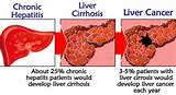 Carcinoma Liver Images
