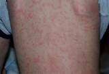 Photos of Benign Rash