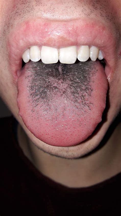 blau schwarze zunge  ist das gesundheit koerper mund