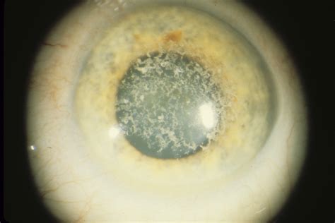 corneal dystrophy granular hereditary ocular diseases