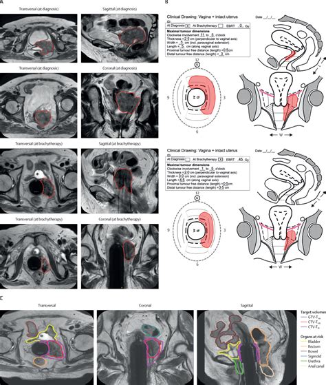 Definitive Radiotherapy With Image Guided Adaptive Brachytherapy For