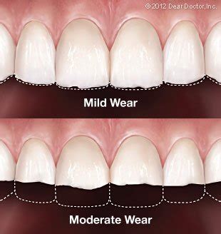 tooth wear inspire dental care