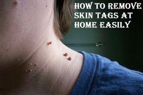 how to remove skin tags at home using home remedies trends and health