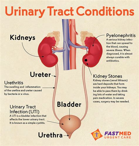 Urinary Tract Infection Uti And Prevention Tips