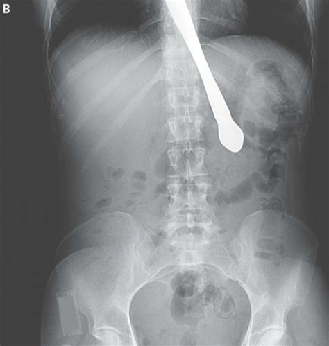 Amazing X Ray Shows How Bulimic Woman Swallowed A Butter Knife While