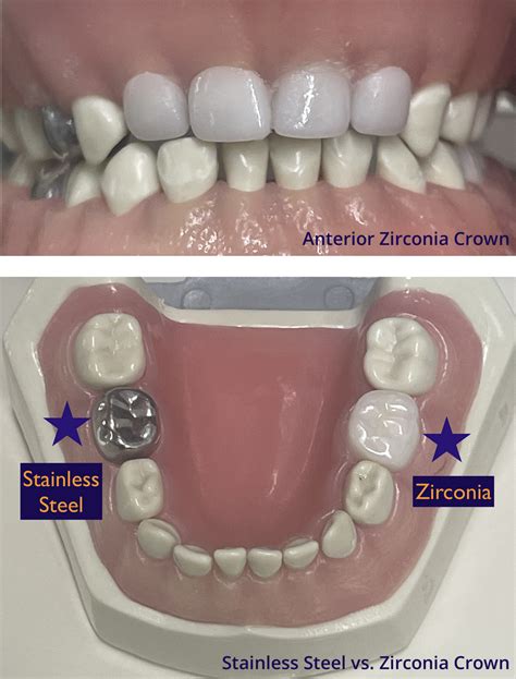 zirconia crowns  fun kids dentist brookfield wi
