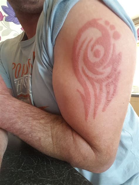 Father Scarred By Black Henna Tattoo He Got On Holiday In Bulgaria