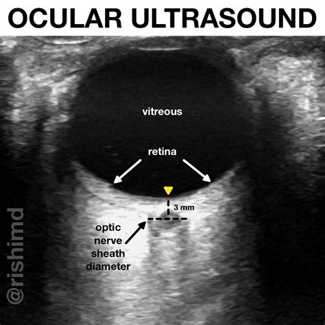 ocular ultrasound  increased intracranial pressure rkmd