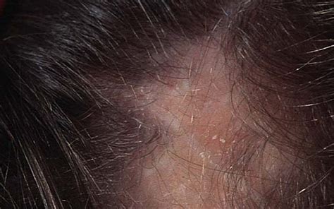 Lupus Hair Loss How To Deal With Lupus Hair Loss Capilia Orando