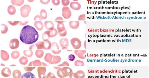 normal  abnormal variants visuals platelet morphology med
