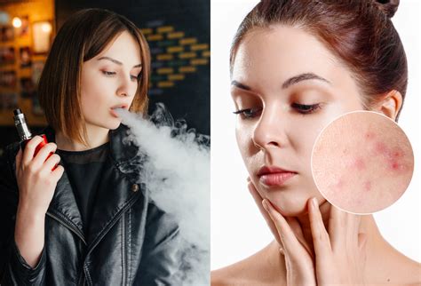 Does Vaping Cause Acne Lets Find Out Forever Acne Free
