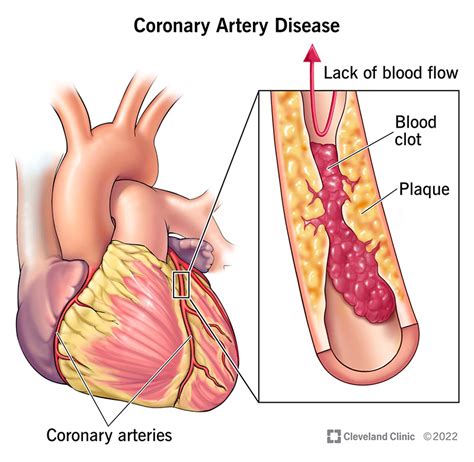 clogged artery symptom