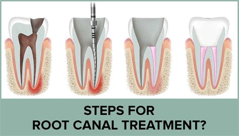 root canal treatment tooth filling cost