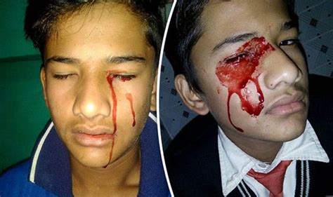 ultra rare condition causes teen to bleed from his eyes ears and mouth world news express