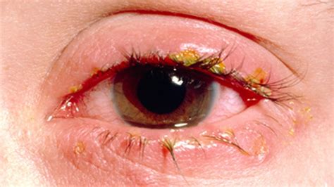 pimple  eyelid types    treat