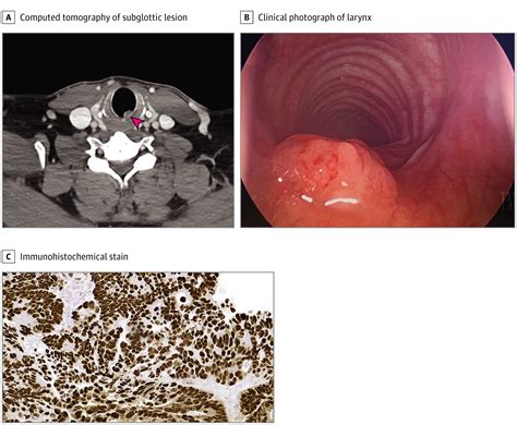 Posterior Subglottic Mass In A Patient With A History Of Rectal