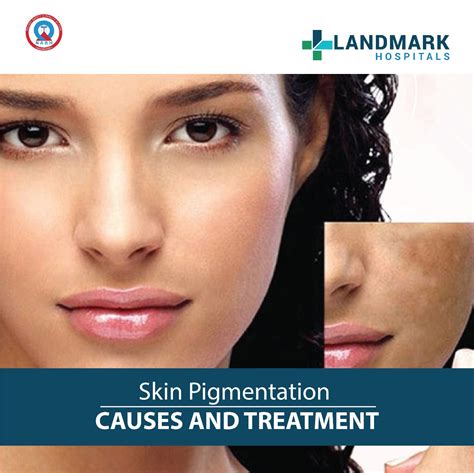 skin pigmentation   treatment landmark hospitals