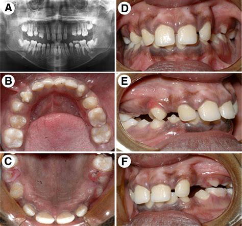 Orthodontic Consequences Of Ritual Dental Mutilations In Northern Tchad