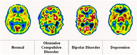 bipolar brain imaging   major breakthrough bipolar lives