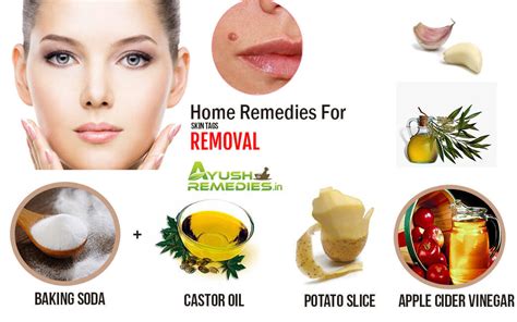 6 natural home remedies for skin tags homemade tips from kitchen