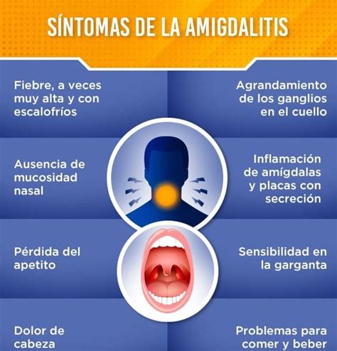 Síntomas De La Amigdalitis Signos Causas Bacteriana Y Más