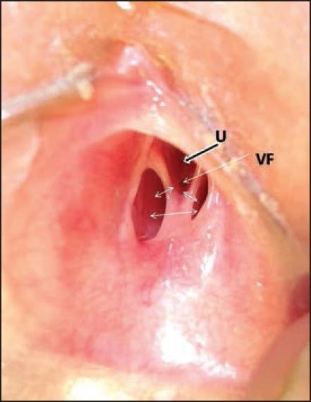 Sex during a vaginal fistula